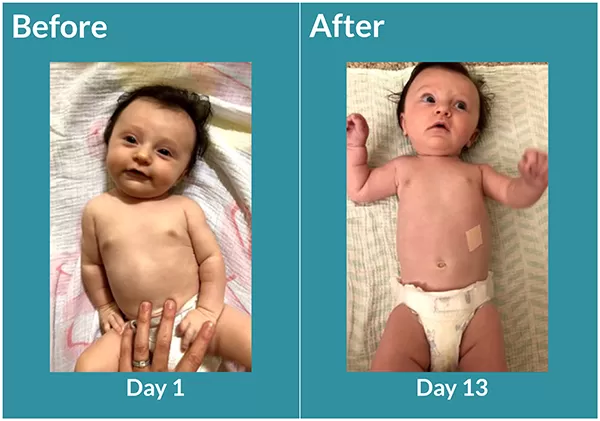 3-month-old infant with torticollis, neck straightens in 13 days.