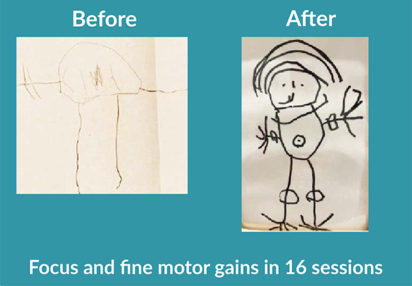 Before drawing: Lightly drawn with little detail. After drawing: Drawing of a person with details, drawn with bold, confident strokes. Text: Focus and fine-motor gains in 16 sessions.