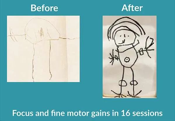Before and after drawings of people. Text: Focus and fine-motor gains in 16 sessions.