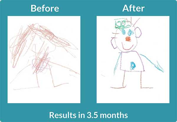 Two side by side 'before and after" drawings showing more colorful, detailed, advanced drawing after 3.5 months using rhythmic movements and primitive reflex integration. Links to a case study titled, "Girl Meets all OT Goals!"