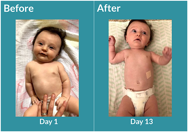 Picture infant with Torticollis before and after. Text: Help for infant Torticollis.