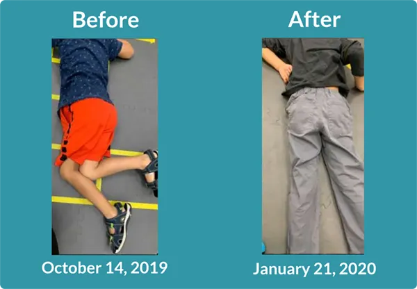 Before and after photos of a young boy with scoliosis showing improvements in spinal alignment