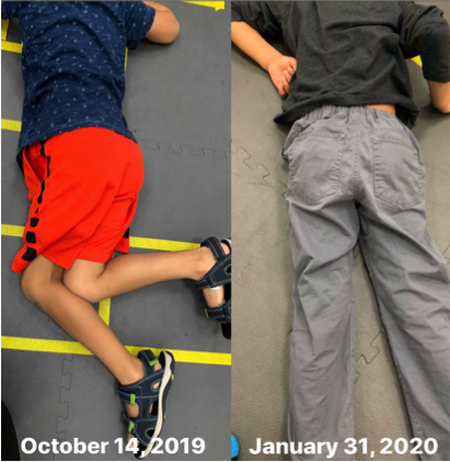 Before photo showing boy who could not lie flat in prone position on October 14, 2019, and After photo showing boy lying flat on January 31, 2020