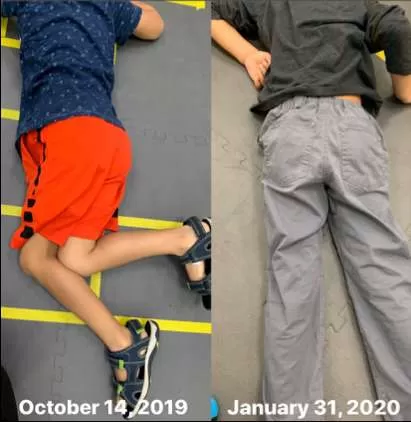 Before photo showing boy who could not lie flat in prone position on October 14, 2019, and After photo showing boy lying flat on January 31, 2020