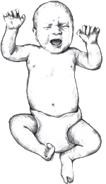 Baby in supine, crying.