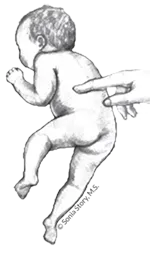 Drawing of an infant in prone lifting hip and leg in response to stimulation on the spine by an adult hand.